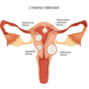 common-symtoms-fibroids