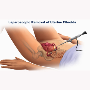 removal_of_the_fibroids
