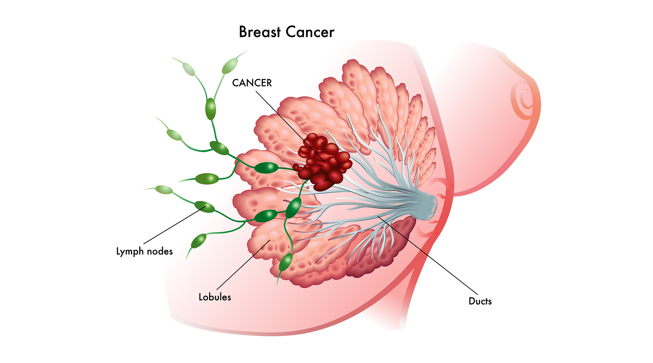 Surgery for Breast Cancer Jalandhar, Punjab