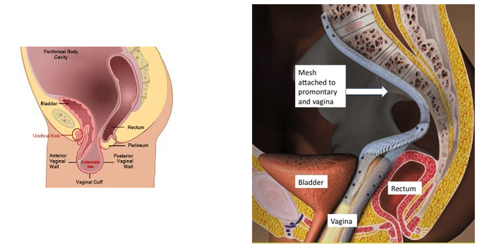 Vaginal Vault Prolapse