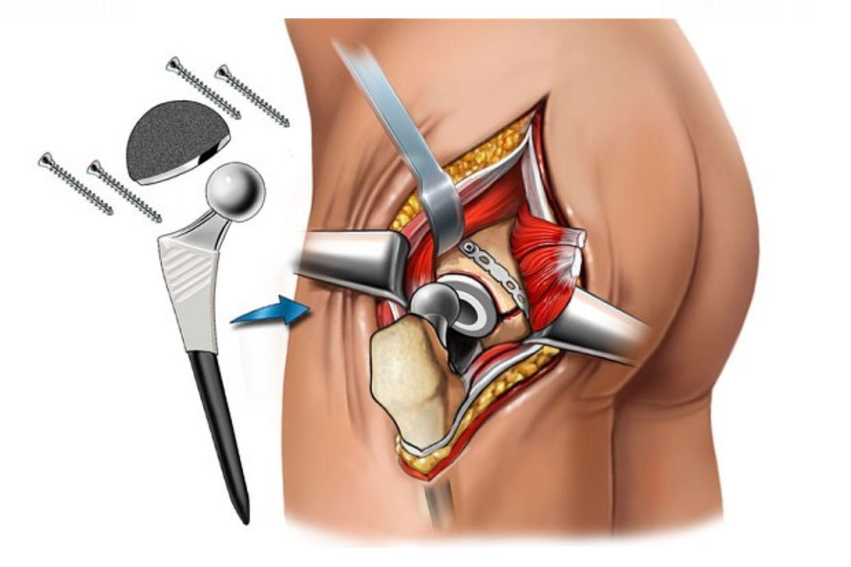robotic hip replacement in Himachal Pradesh